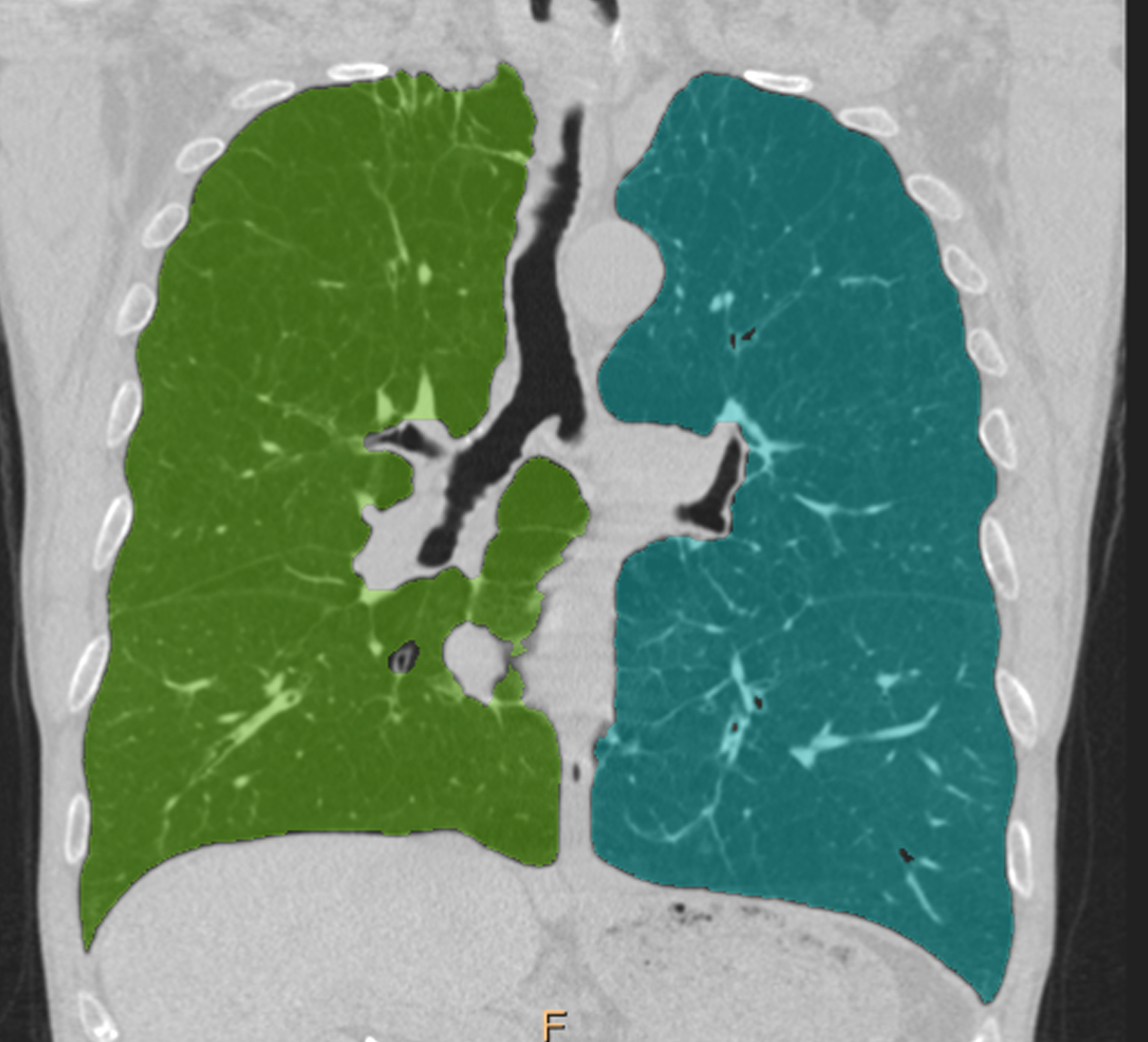 Emphysema Distribution Emphysema quantification | Radiology SA